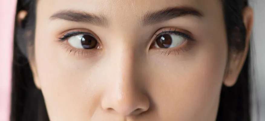 Things To Know About Lazy Eyes, Crossed Eyes, And Red Eyes